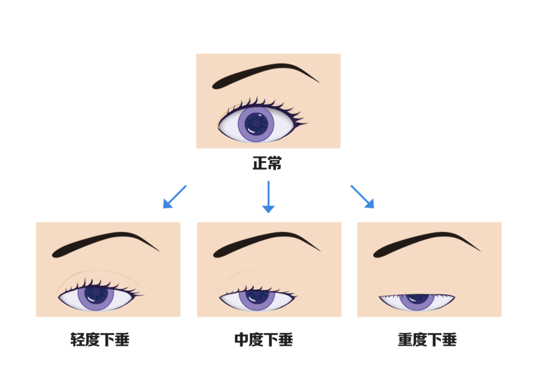 上瞼下垂怎么治療