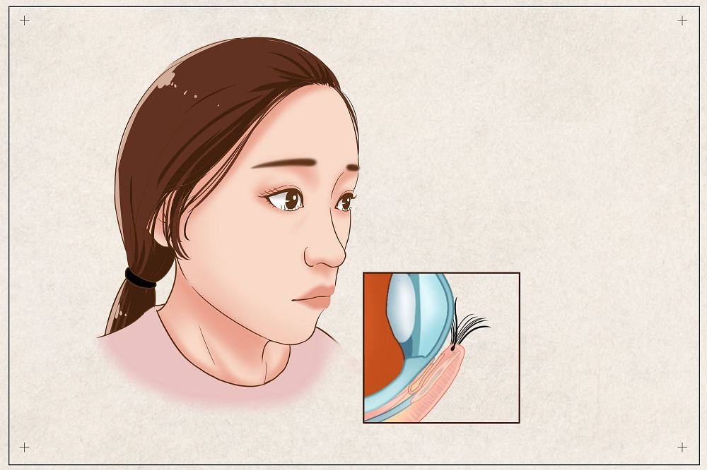 倒睫會(huì)自己好嗎？